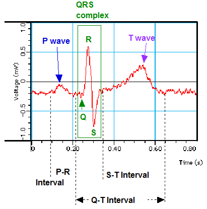 example EKG